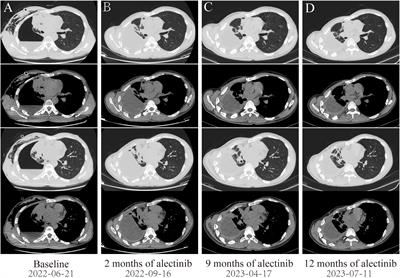 Novel PPFIA1-ALK, ALK-C2orf91(intergenic) double-fusion responded well to alectinib in an advanced lung adenocarcinoma patient: a case report
